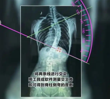 脊柱側(cè)彎輔助測(cè)量軟件gd-ais