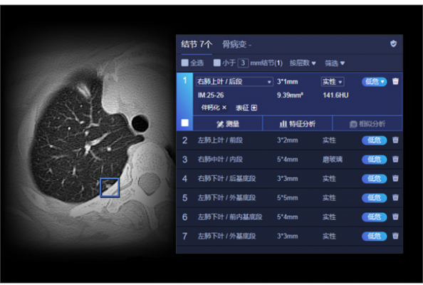 肺結節(jié)ct圖像輔助檢測軟件uai-pioneerchest聯影