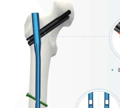 金興達帶鎖髓內(nèi)釘系統(tǒng)