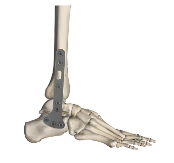 奧斯邁足踝鎖定接骨板系統(tǒng)