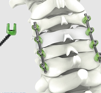 椎板固定板系統(tǒng)威高