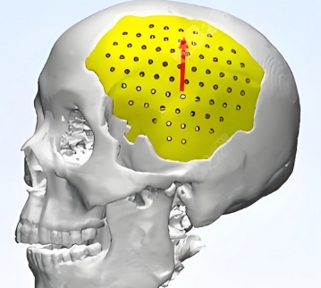 大博顱骨修補(bǔ)重建系統(tǒng)