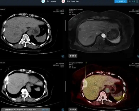 肝臟ct影像處理軟件