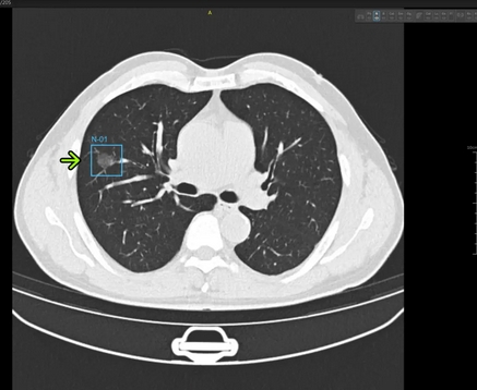 肺結節(jié)ct影像輔助分診軟件