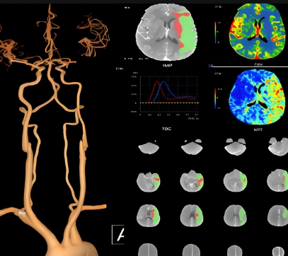 腦灌注ct圖像處理軟件