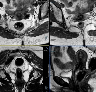 直腸mri醫(yī)學影像存儲傳輸與處理軟件